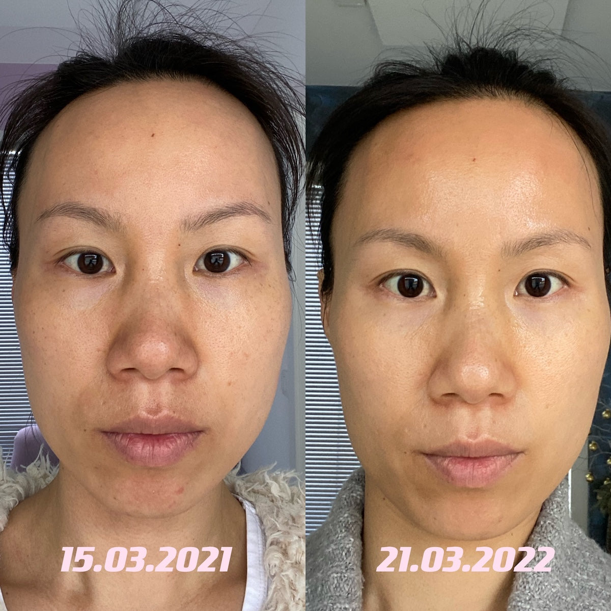 Resnični rezultati Eurona 5-v-1: Moja koža prej in po enem letu uporabe. Vidno manjše pore, enakomeren ten in čvrsta, sijoča polt brez rdečice.